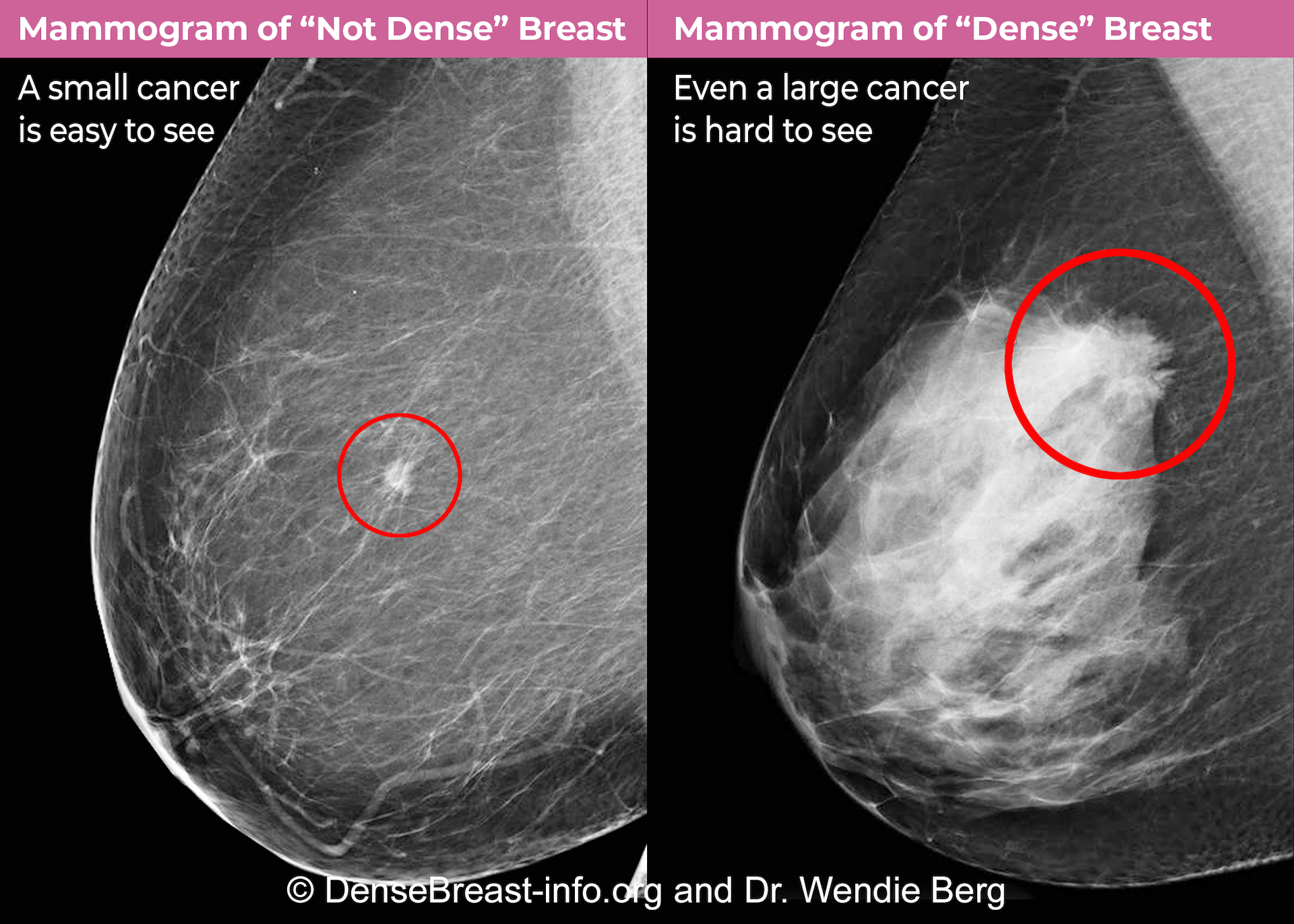 The FDA's rule change requiring providers to inform women about breast  density could lead to a flurry of questions - Women's Healthcare