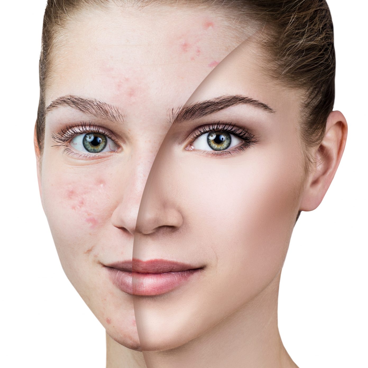 Updates In Adult Female Acne Womens Healthcare