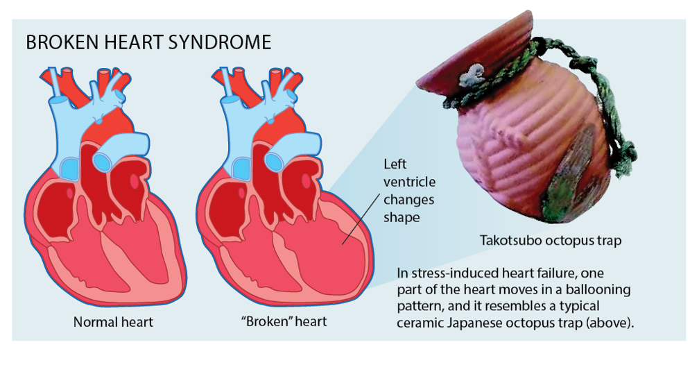 Mental Health Disorders In Women Associated With Increased Risk For Broken Heart Syndrome New
