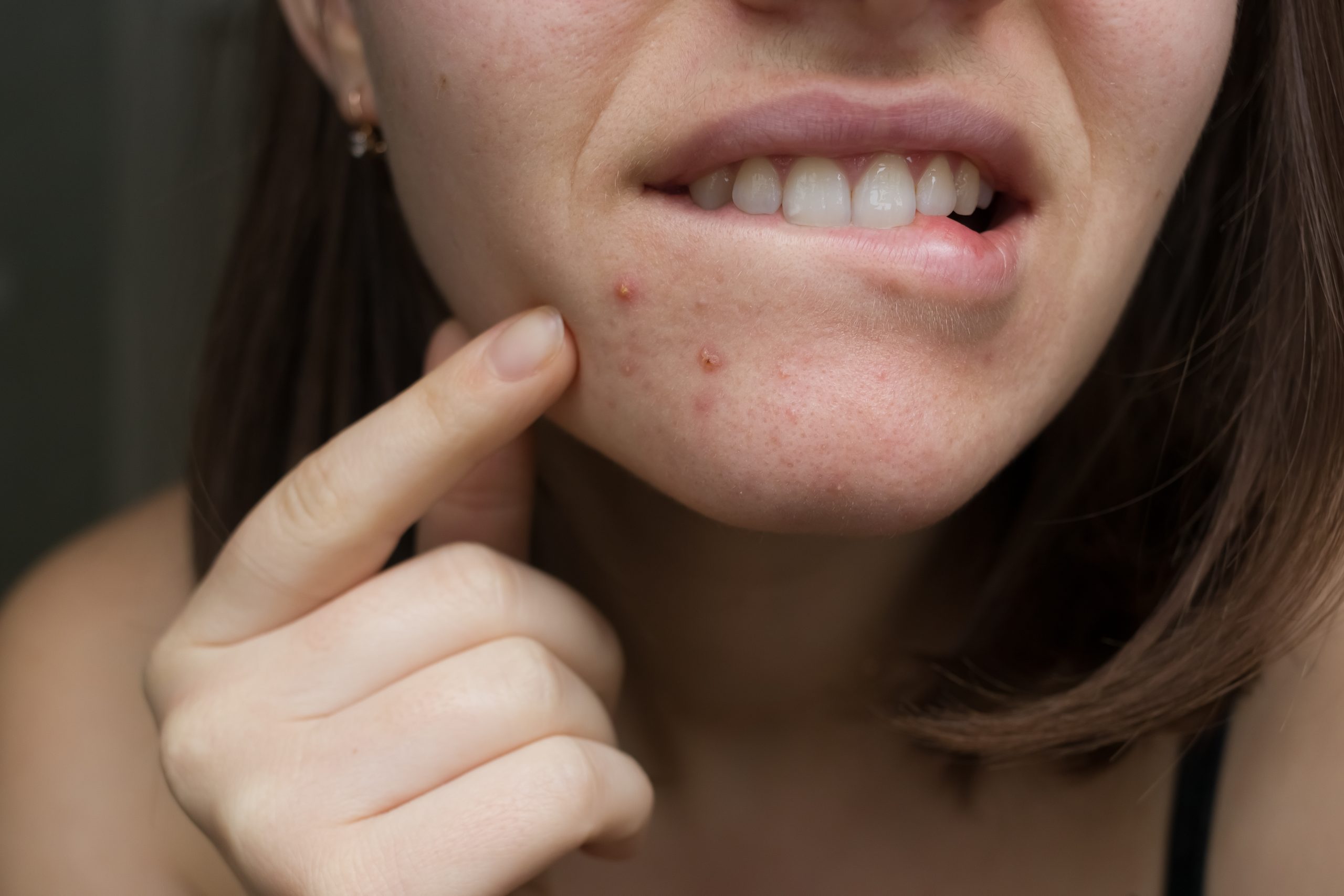 Acne, Rosacea, and Other Acneiform Conditions